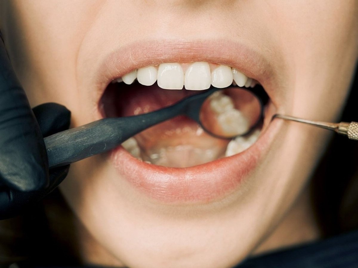 Mất răng hàm số 6, phục hồi bằng 1 trụ Implant