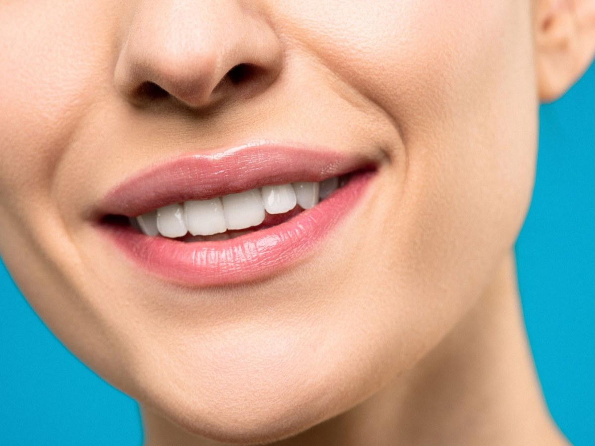 Răng cửa mẻ và thưa, phục hồi bằng 6 mặt dán sứ