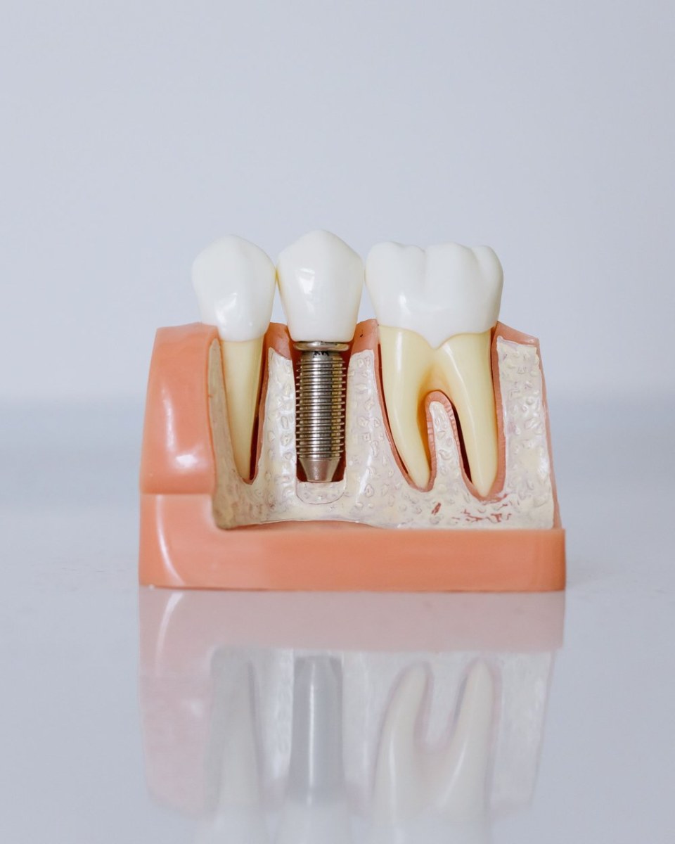 Cấy ghép Implant