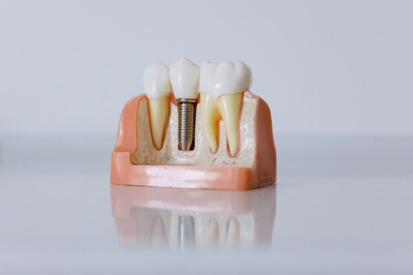 Mất răng lâu năm có cấy Implant được không?