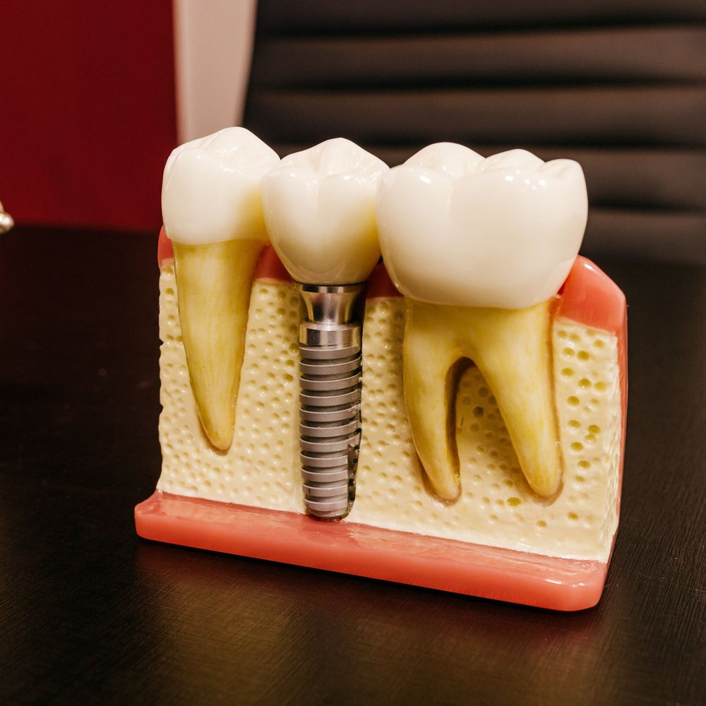 Cấy ghép Implant cao cấp