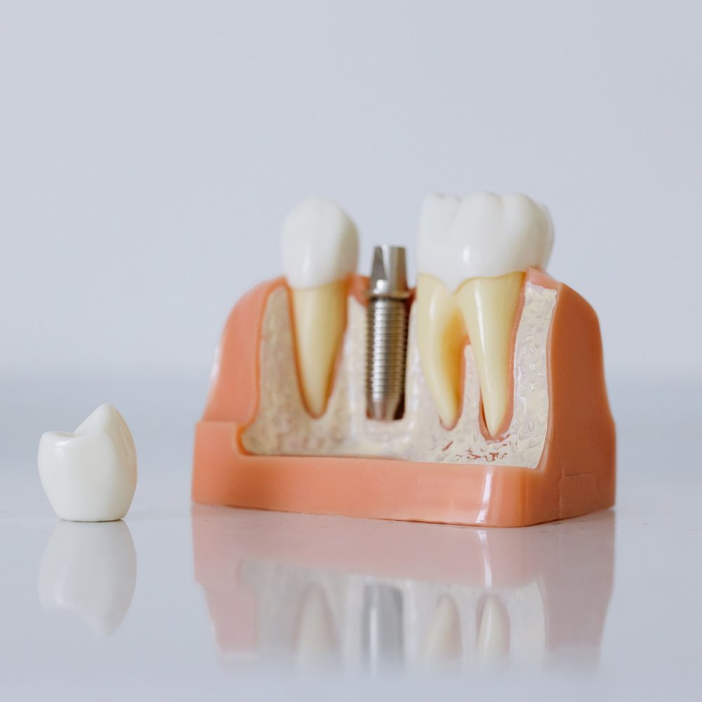Cấy ghép Implant tiêu chuẩn