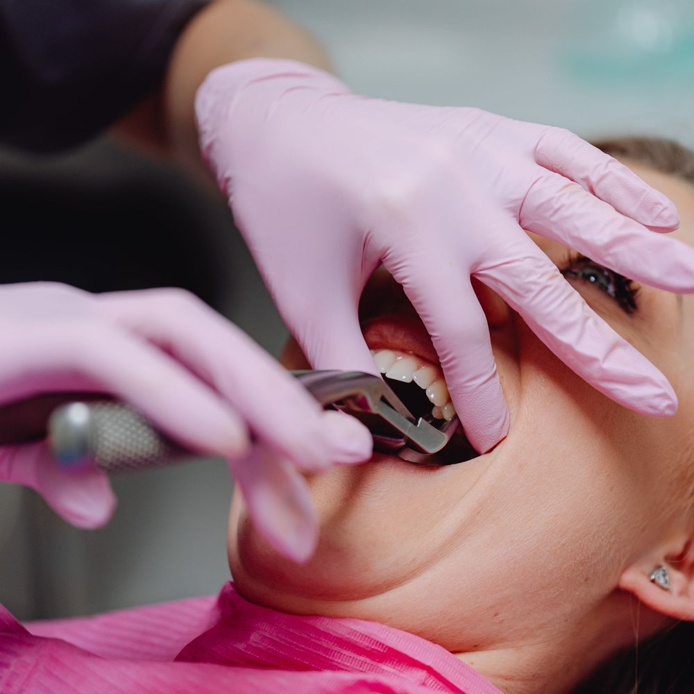 Nhổ răng khôn mọc ngầm bằng máy Piezotome