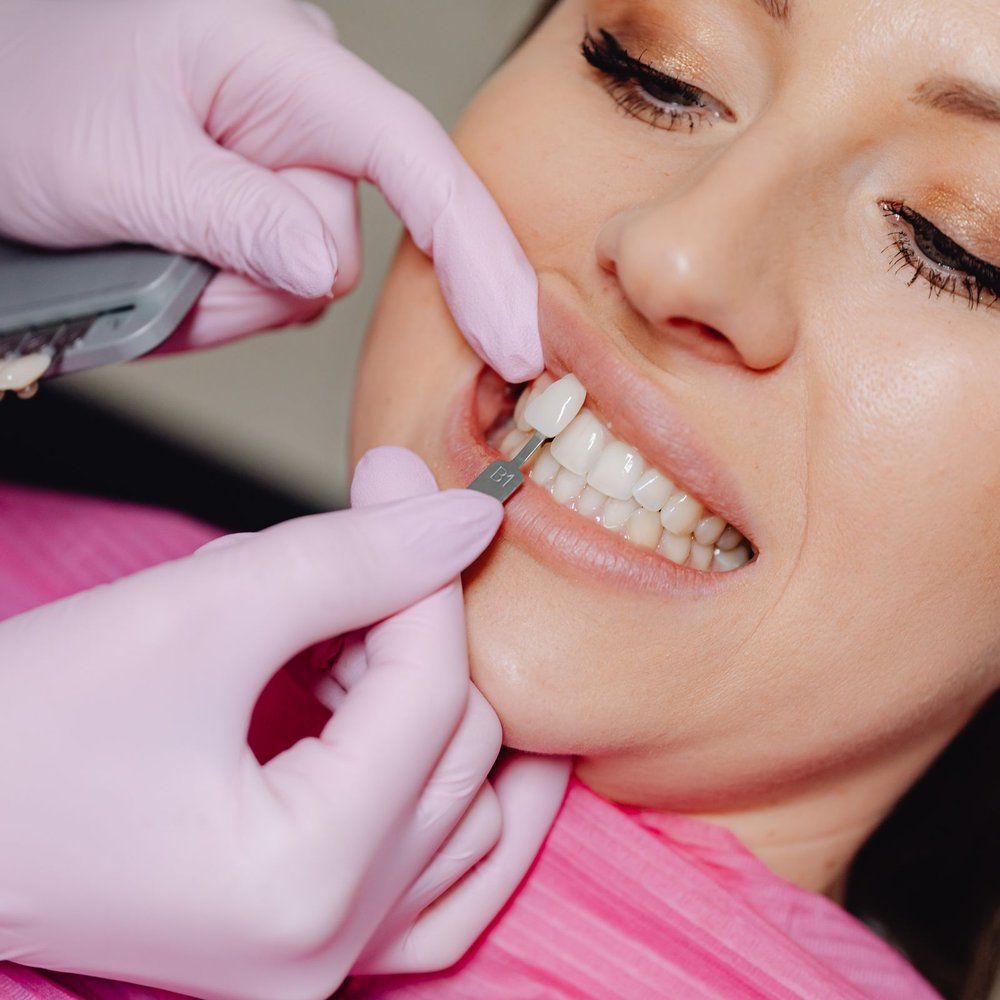 Mặt dán sứ Veneer Emax